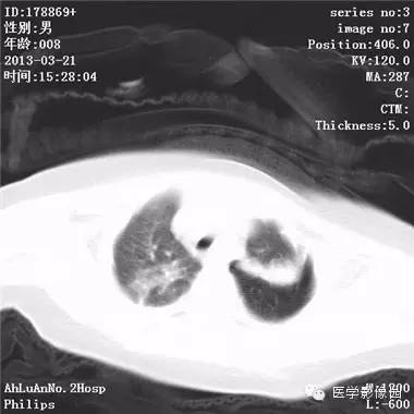 【病例】支气管异物1例CT影像表现 【病例】支气管异物1例CT影像表现