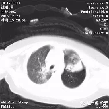 【病例】支气管异物1例CT影像表现 【病例】支气管异物1例CT影像表现