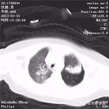 【病例】支气管异物1例CT影像表现 【病例】支气管异物1例CT影像表现