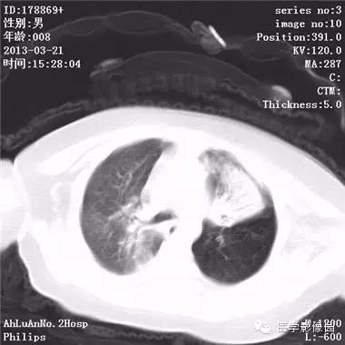 【病例】支气管异物1例CT影像表现 【病例】支气管异物1例CT影像表现