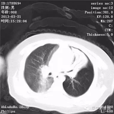 【病例】支气管异物1例CT影像表现 【病例】支气管异物1例CT影像表现