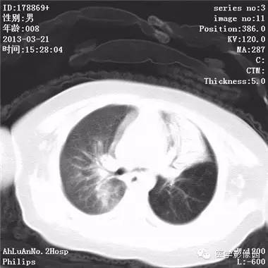 【病例】支气管异物1例CT影像表现 【病例】支气管异物1例CT影像表现