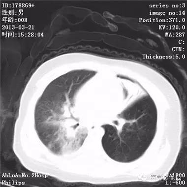 【病例】支气管异物1例CT影像表现 【病例】支气管异物1例CT影像表现