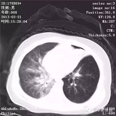 【病例】支气管异物1例CT影像表现 【病例】支气管异物1例CT影像表现