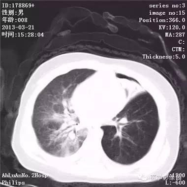 【病例】支气管异物1例CT影像表现 【病例】支气管异物1例CT影像表现