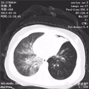 【病例】支气管异物1例CT影像表现 【病例】支气管异物1例CT影像表现