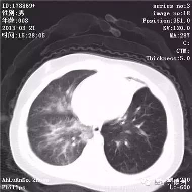 【病例】支气管异物1例CT影像表现 【病例】支气管异物1例CT影像表现