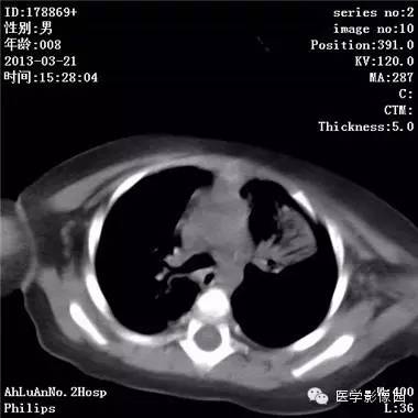 【病例】支气管异物1例CT影像表现 【病例】支气管异物1例CT影像表现