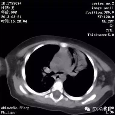 【病例】支气管异物1例CT影像表现 【病例】支气管异物1例CT影像表现