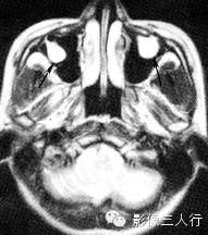 鼻窦囊肿的鉴别诊断 鼻窦囊肿的鉴别诊断