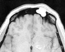 鼻窦囊肿的鉴别诊断 鼻窦囊肿的鉴别诊断
