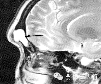 鼻窦囊肿的鉴别诊断 鼻窦囊肿的鉴别诊断