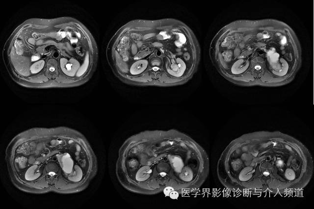 【病例】肾门神经鞘瘤1例MR影像表现