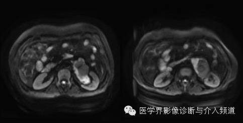 【病例】肾门神经鞘瘤1例MR影像表现 【病例】肾门神经鞘瘤1例MR影像表现