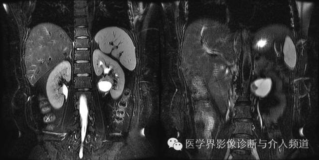 【病例】肾门神经鞘瘤1例MR影像表现 【病例】肾门神经鞘瘤1例MR影像表现