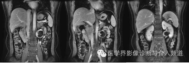 【病例】肾门神经鞘瘤1例MR影像表现 【病例】肾门神经鞘瘤1例MR影像表现