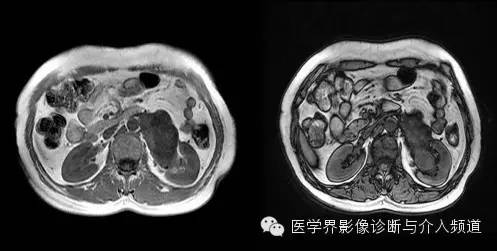 【病例】肾门神经鞘瘤1例MR影像表现 【病例】肾门神经鞘瘤1例MR影像表现