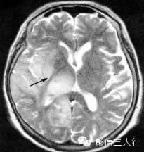各级星形细胞瘤鉴别诊断 各级星形细胞瘤鉴别诊断