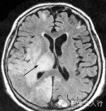各级星形细胞瘤鉴别诊断