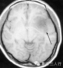 各级星形细胞瘤鉴别诊断 各级星形细胞瘤鉴别诊断