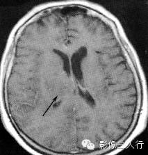 各级星形细胞瘤鉴别诊断 各级星形细胞瘤鉴别诊断