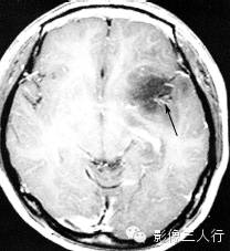 各级星形细胞瘤鉴别诊断 各级星形细胞瘤鉴别诊断