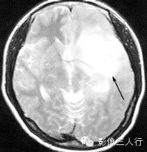 各级星形细胞瘤鉴别诊断 各级星形细胞瘤鉴别诊断