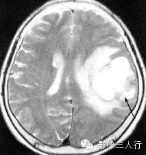 各级星形细胞瘤鉴别诊断 各级星形细胞瘤鉴别诊断