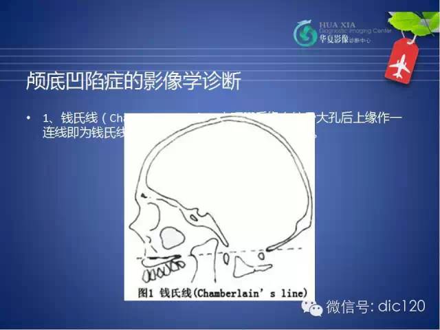 【PPT】原发性颅底凹陷症的影像学诊断