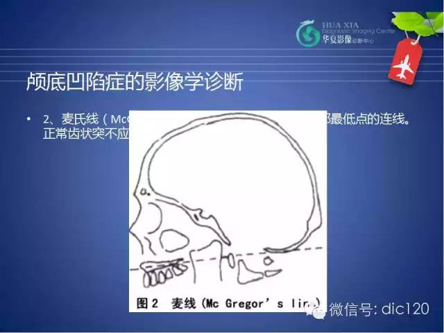 【PPT】原发性颅底凹陷症的影像学诊断