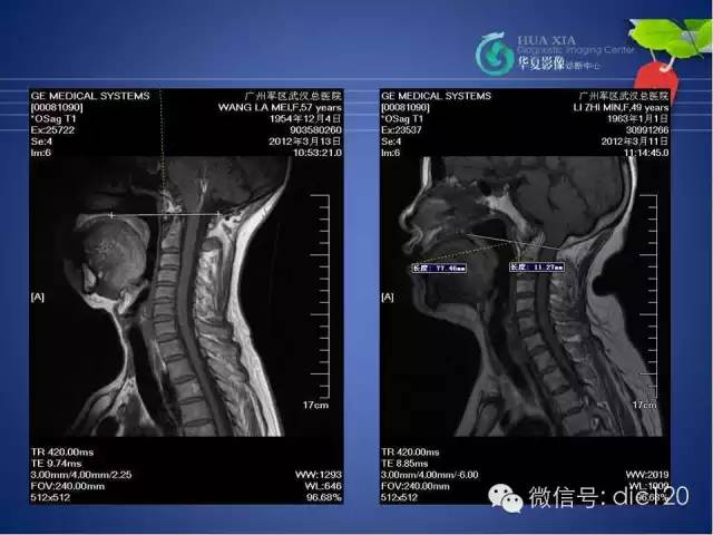 【PPT】原发性颅底凹陷症的影像学诊断