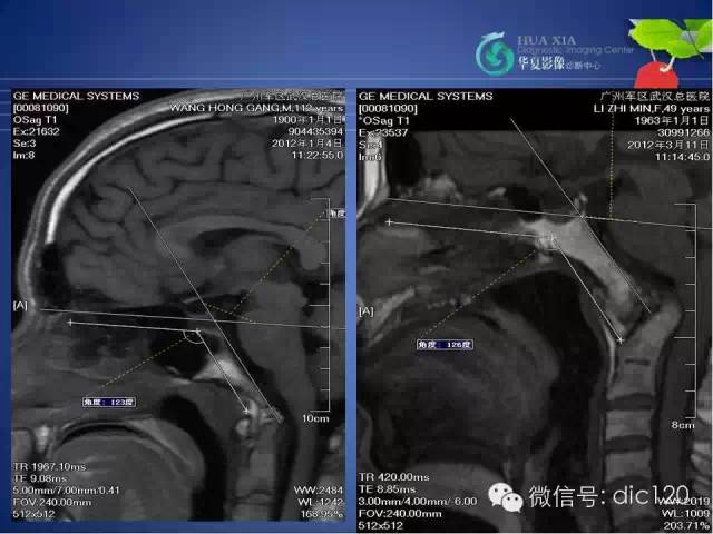 【PPT】原发性颅底凹陷症的影像学诊断