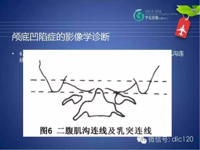 【PPT】原发性颅底凹陷症的影像学诊断