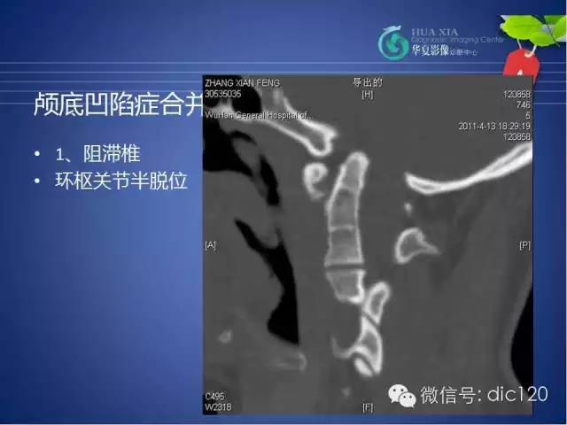 【PPT】原发性颅底凹陷症的影像学诊断