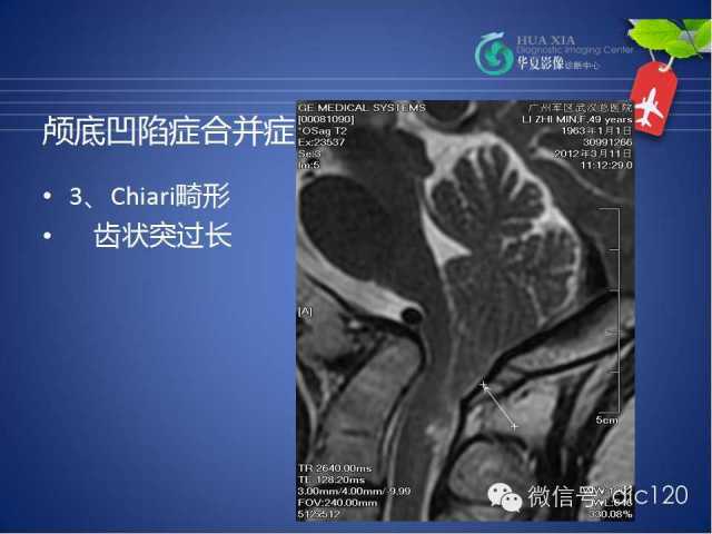 【PPT】原发性颅底凹陷症的影像学诊断