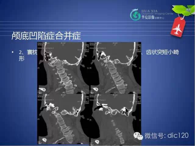 【PPT】原发性颅底凹陷症的影像学诊断