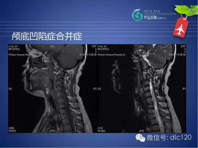 【PPT】原发性颅底凹陷症的影像学诊断