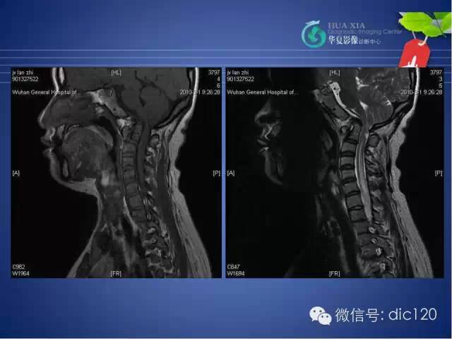 【PPT】原发性颅底凹陷症的影像学诊断
