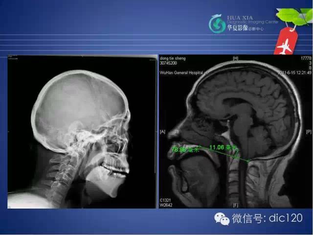 【PPT】原发性颅底凹陷症的影像学诊断