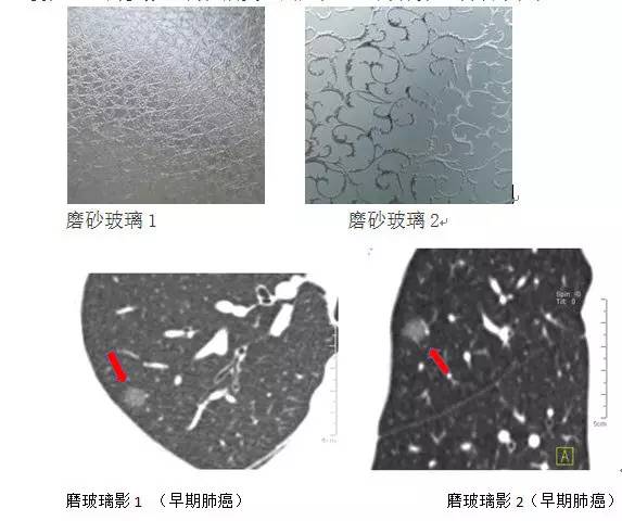 肺部毛玻璃样变=肺癌?一文解析你不知道的 GGO 肺部毛玻璃样变=肺癌?一文解析你不知道的 GGO