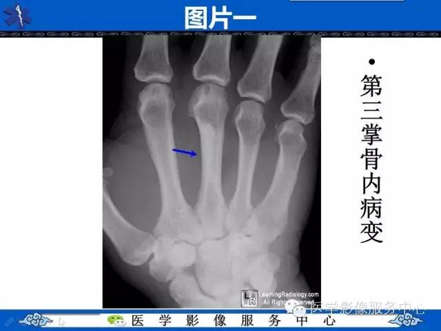 【影像征象】滴蜡征——蜡泪样骨病