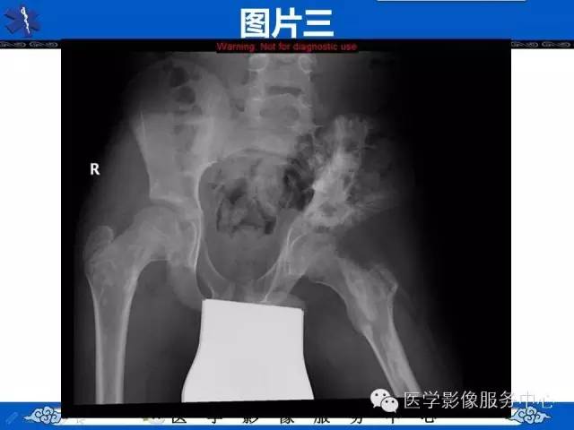 【影像征象】滴蜡征——蜡泪样骨病