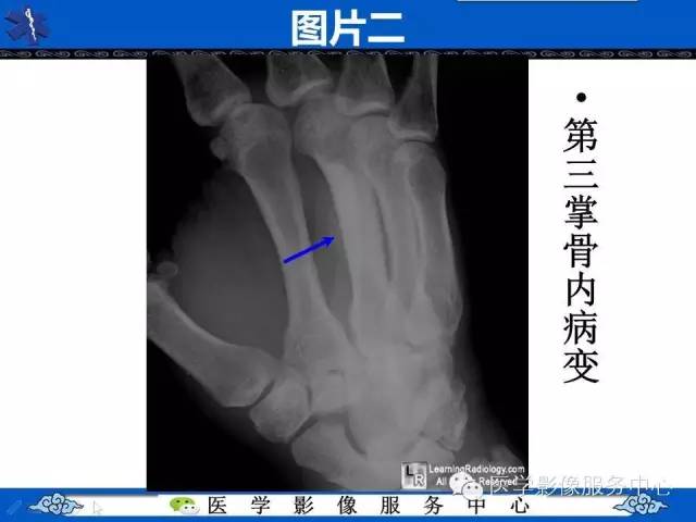 【影像征象】滴蜡征——蜡泪样骨病
