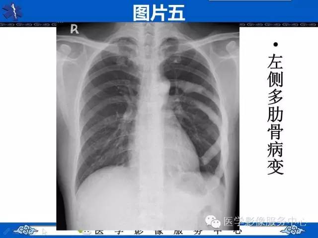 【影像征象】滴蜡征——蜡泪样骨病