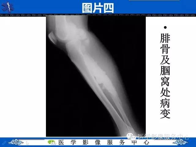 【影像征象】滴蜡征——蜡泪样骨病