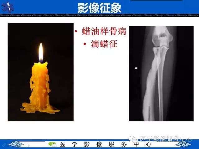 【影像征象】滴蜡征——蜡泪样骨病
