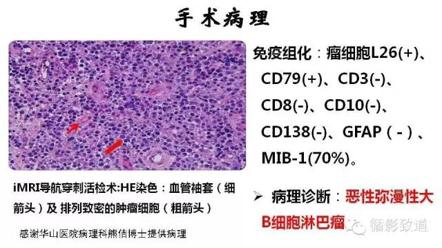 【病例】中枢神经系统淋巴瘤1例MR影像表现