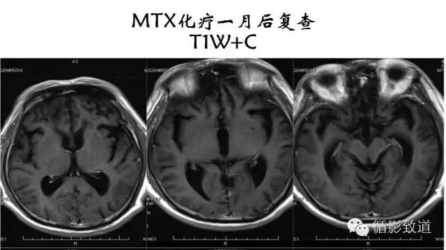 【病例】中枢神经系统淋巴瘤1例MR影像表现