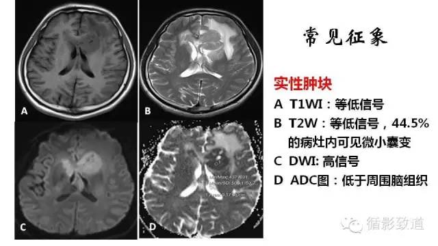 【病例】中枢神经系统淋巴瘤1例MR影像表现