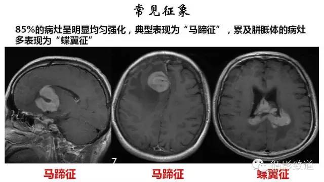 【病例】中枢神经系统淋巴瘤1例MR影像表现